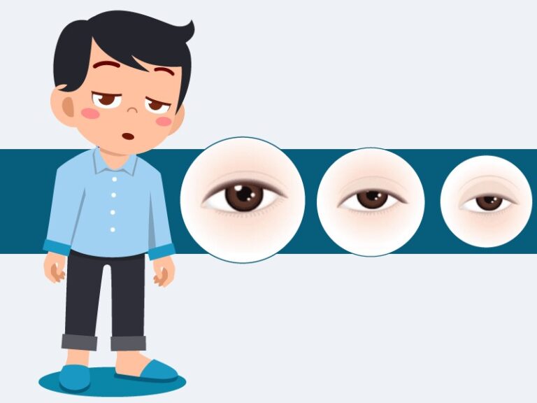 All About Ptosis or Droopy Eyelids